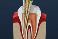 Метод пломбирования каналов с помощью гуттаперчевых штифтов Метод пломбирования каналов с помощью гуттаперчевых штифтов